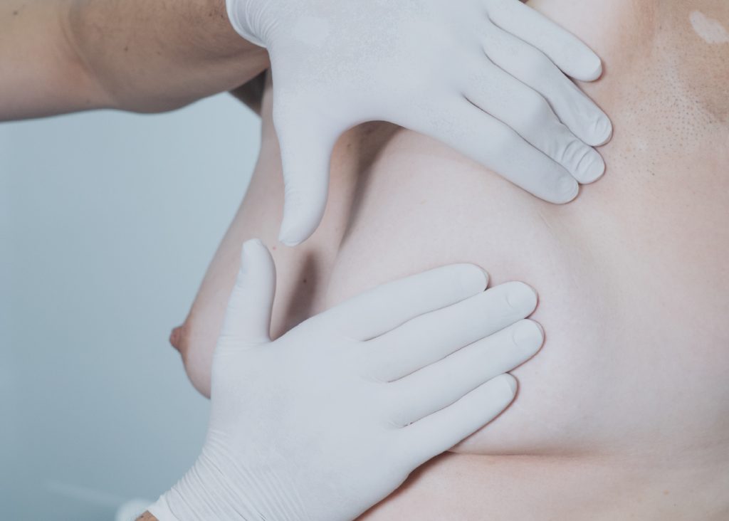 Promoción, Prevención y Detección del Cáncer de Mama