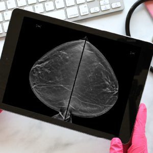 Aspectos clinicos y diagnosticos del cancer de mama