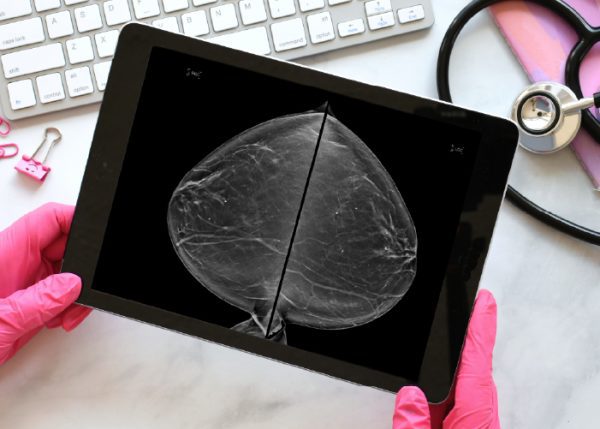 Aspectos clinicos y diagnosticos del cancer de mama